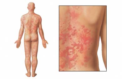 DERMATITIS ATÓPICA