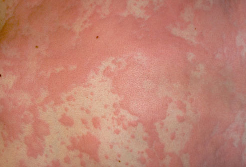 URTICARIA