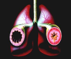 bronquios normales y en el asma