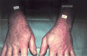 dermatitis de contacto profesional_page1_image1