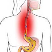 ESOFAGITIS EOSINOFÍLICA 