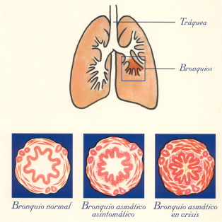 ASMA BRONQUIAL E INFLAMACIÓN