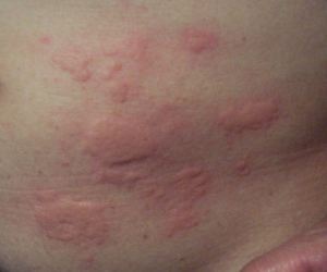 urticaria