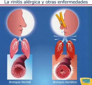 LA RINITIS ALÉRGICA PUEDE LLEVAR AL ASMA EN EL TIEMPO