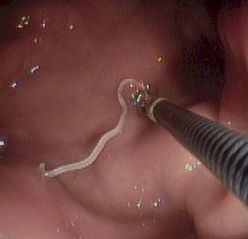 anisakis Y ENDOSCOPIA